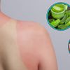 Cách chữa da cháy nắng hiệu quả tại nhà