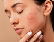 Những bí quyết giúp phòng tránh mụn ẩn hiệu quả