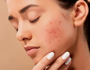 Những bí quyết giúp phòng tránh mụn ẩn hiệu quả