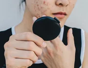 Xu hướng TikTok: Sử dụng nước muối biển để trị mụn, nên hay không?