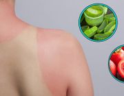 Cách chữa da cháy nắng hiệu quả tại nhà
