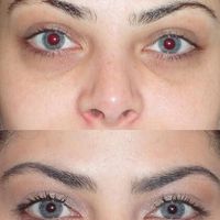 Tiêm filler vùng rãnh lệ