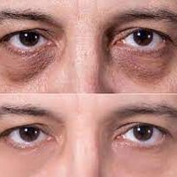 Tiêm filler vùng rãnh lệ