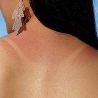 Cách chữa da cháy nắng hiệu quả tại nhà