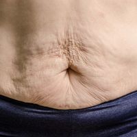 Các biện pháp giúp săn chắc da sau giảm cân