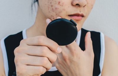 Xu hướng TikTok: Sử dụng nước muối biển để trị mụn, nên hay không?