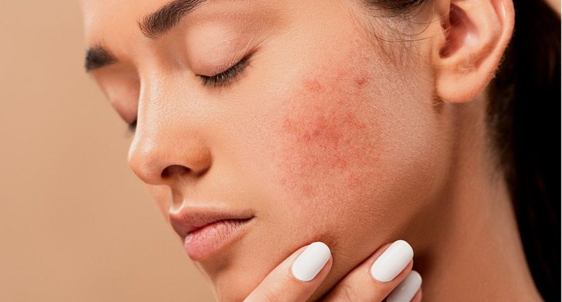 Những bí quyết giúp phòng tránh mụn ẩn hiệu quả