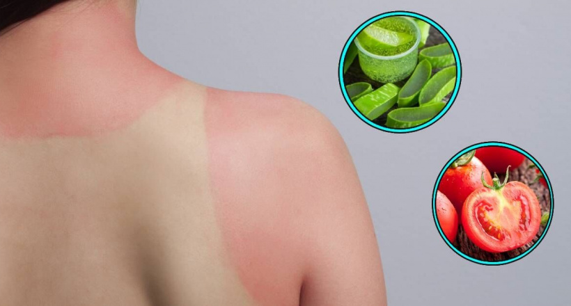 Cách chữa da cháy nắng hiệu quả tại nhà