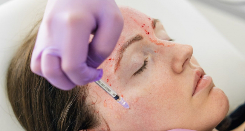 Tìm hiểu về liệu pháp làm đẹp “ma cà rồng” của dàn sao thế giới