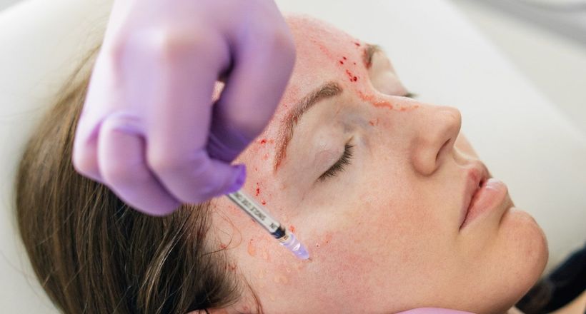Tìm hiểu về liệu pháp làm đẹp “ma cà rồng” của dàn sao thế giới