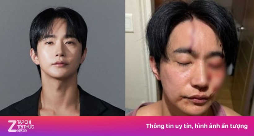 Nam diễn viên bị bạn gái cũ bạo hành