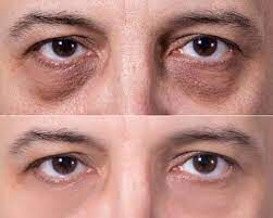 Tiêm filler vùng rãnh lệ