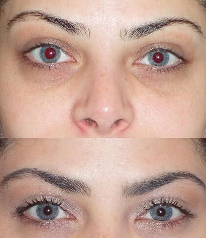 Tiêm filler vùng rãnh lệ