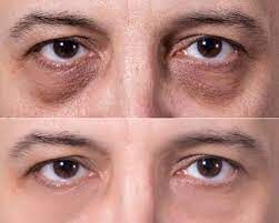 Tiêm filler vùng rãnh lệ