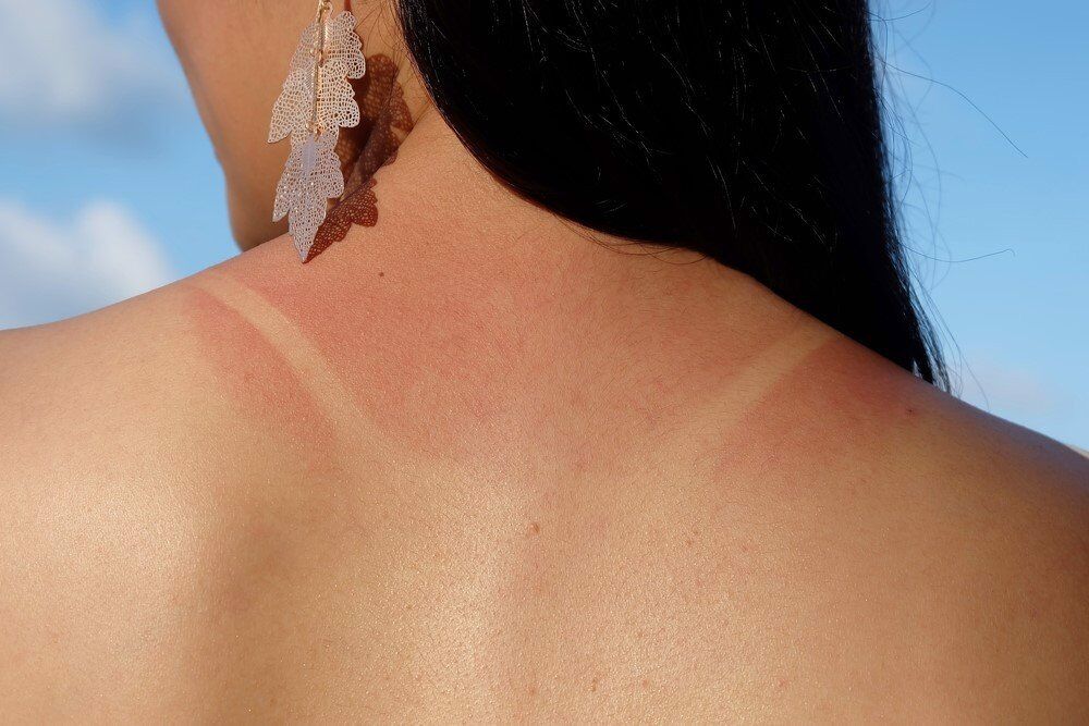 Cách chữa da cháy nắng hiệu quả tại nhà