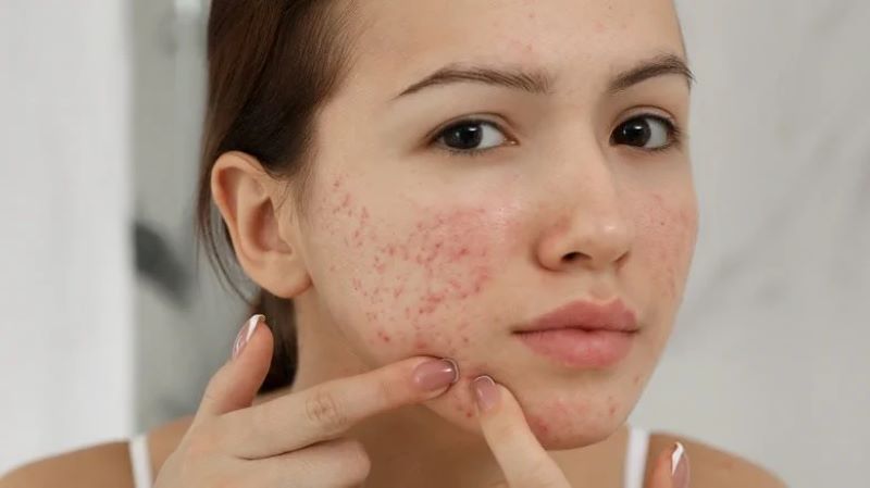4 cách khắc phục tổn thương da thường gặp sau tết